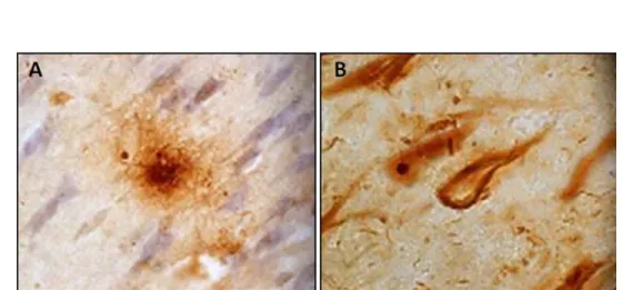 Figura 1. Estructuras neuropatológicas identificadas en el tejido cerebral de pacientes que padecieron la EA 