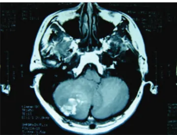 Figura 1.  Imagen de resonancia magnética cráneal secuencia T1 que demuestra proceso tumoral en hemisferio cerebeloso  dere-cho, heterogéneo e hiperintenso con efecto compresivo impor tante.