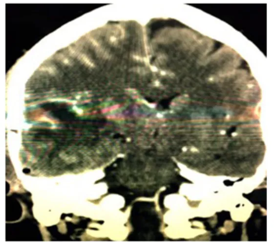 Figura 3.3  TAC de cráneo posoperatoria se observa au- au-mento del edema lóbulo temporal