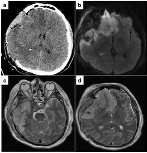 Figura 3. a) Tomografía simple de cráneo posquirúrgica, se observa una  hipodensidad en territorio de la arteria cerebral anterior
