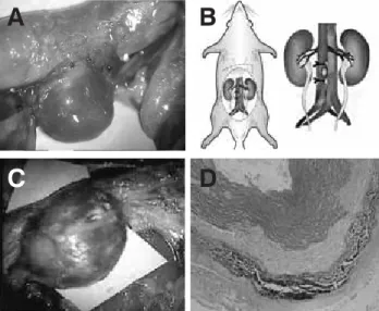Figura 1. A. Aneurisma de implantación reciente. B. Esquema del