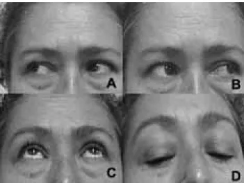 Figura 6. Resultados quirúrgicos. Caso correspondiente a figura 5. En esta fotografía se presenta al paciente 6 meses después de la  interven-ción quirúrgica con recuperainterven-ción total de los movimientos oculares.