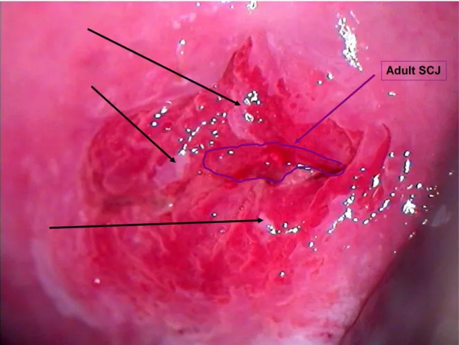 Fig. 3: La colposcopia de una mujer de 25 años con una nueva Zona de Transformación con islas de 