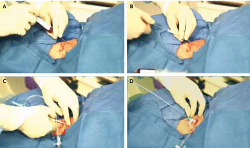 Figure 2.  Sheath Insertion with the Modified Seldinger Technique.