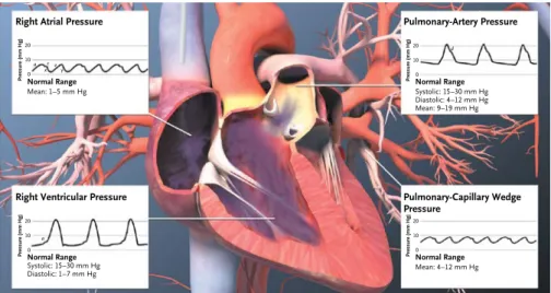 Figure 3.  Pressure Waveforms in the Right Heart and Pulmonary Artery.