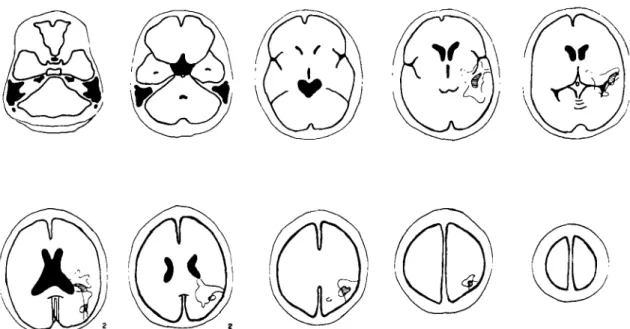 FIG.  2.  Dysphasic  seizures. Superimpasition  of  the  CT  scan  paroxysmal  alexia are shown (HC 3741  1  and  HC  35269)