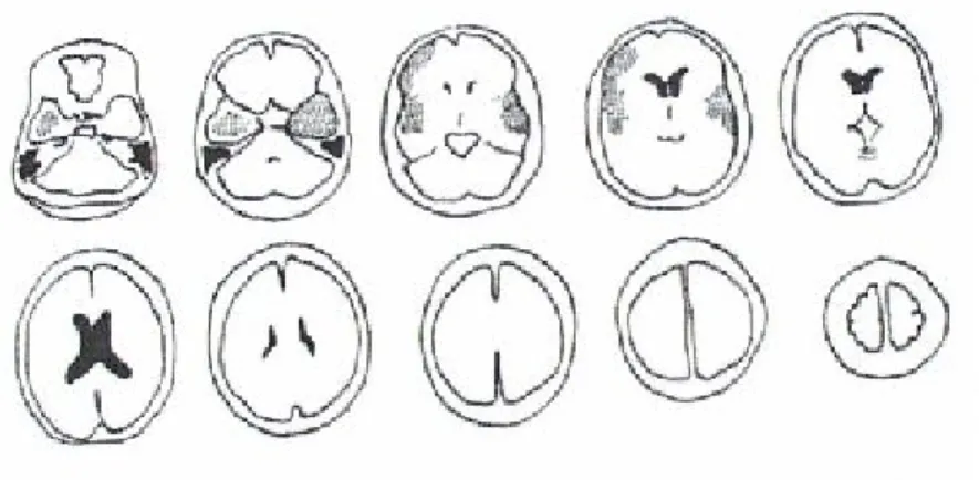 Figura 3.1. Esquema de la lesión 