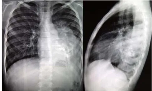Figura 1. Radiografía AP y lateral de tórax con imagen radiopaca en zona basal izquierda  con calcificación central ocupando mediastino posterior