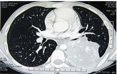 Figura 3. Ventana pulmonar de TAC en fase angiotomográfica: tumoración hemi- hemi-tórax izquierdo de 12.7 x 7.2 x 8.4 cm, ocupando todo el lóbulo inferior,  envol-viendo su arteria, con conglomerados de calcificaciones de 35 mm con nódulos en 