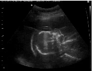 Figura  1.-  US  obstétrico  donde  se  observa  edema  pulmonar bilateral  y  ascitis  fetal.