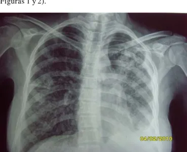 Figura 1.- Rx de la madre con datos radiológicos compatibles con proceso  de  tuberculosis    con  foco  neumónico  apical  izquierdo.