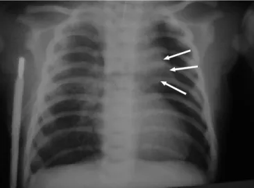 Figura 1.- Radiografía de tórax: muestra opacidad en borde superior izquierdo del mediastino (flechas).