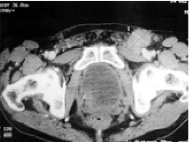 Figura 1. Tomografía por reconstrucción de corte coronal. Se observa crecimiento ganglionar inguinal izquierdo de 39.4 x 34.0 mm.