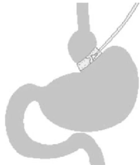 Figura 1. Bypass gástrico con Y