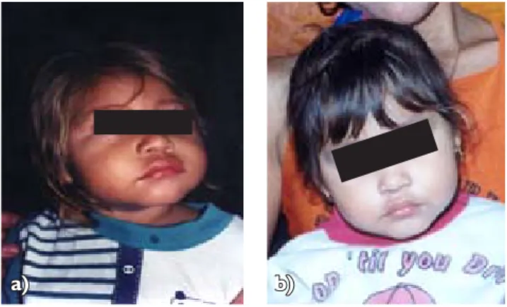 Figura  11111. El caso 1; a) antes (12 meses), y b) después (15