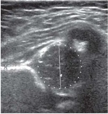 Figura 11 11 11 11 11. Ultrasonido normal de la cadera de un paciente en