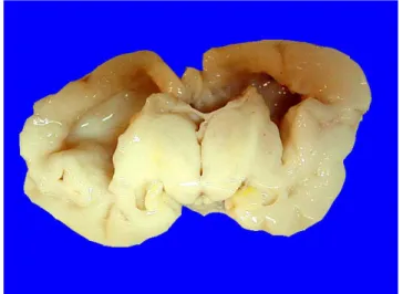 Figura 4. Se identifica una papila renal con necrosis y hemorragia.