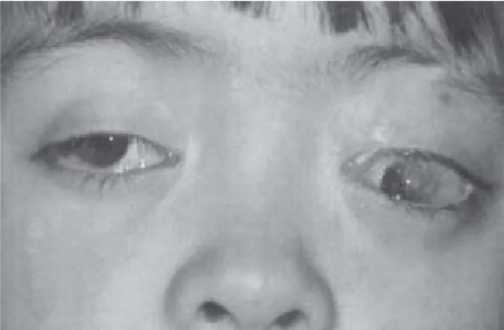 Figura 4. Leucoma corneal vascularizado en ambos ojos con compromiso del eje visual en ojo izquierdo.