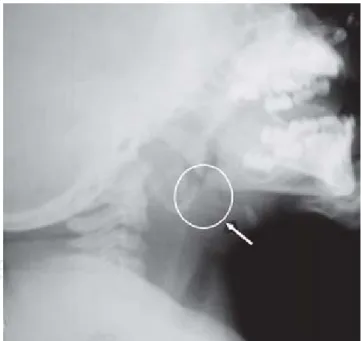 Figura 11111.     Radiografía de cuello perfil de la paciente. La flecha