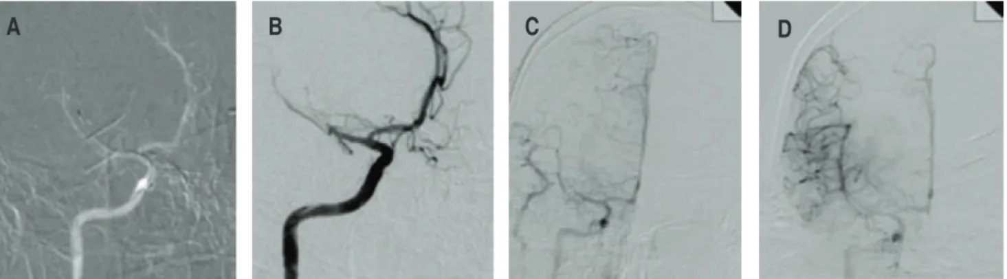 Figure 5:  Cerebral angiography which shows the occlusion of the MRCA M2 segment  (A  y  B) , reperfusion sequence  (C  y  D) .