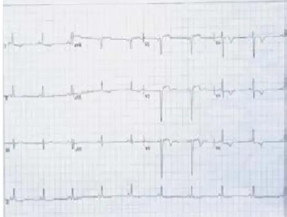 Figure 1:  12-lead electrocardiogram: sinus bradycardia 