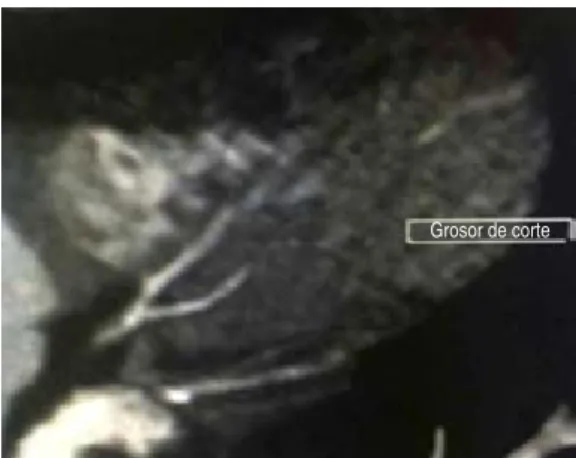 Figure 3:  Coronary angiotomography: diffuse disease 