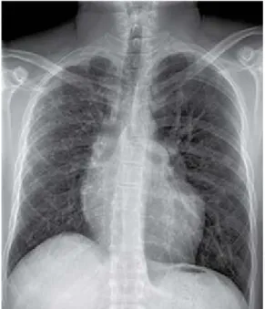 Figure 1:  PA view chest X-ray, showing mild upper  zone vascular flow redistribution with right lung  predominance, along with enlarged pulmonary arteries  with right predominance as well.