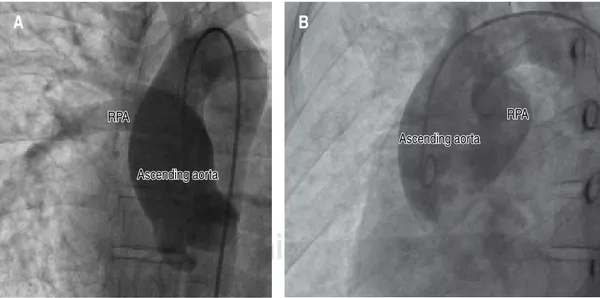 Figure 5:  A. Aortography. Anteroposterior projection with caudal angulation. It is observed the presence of a 5fr  pigtail catheter in the ascending aorta from a femoral access