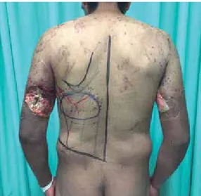 Figura 1.  Paciente que evidencia el defecto en la por- por-ción posterior del brazo (tríceps).