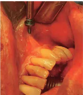 Figura 1.  Colocación de tornillo de titanio autoperfo- autoperfo-rante, evitando la raíz dentaria.