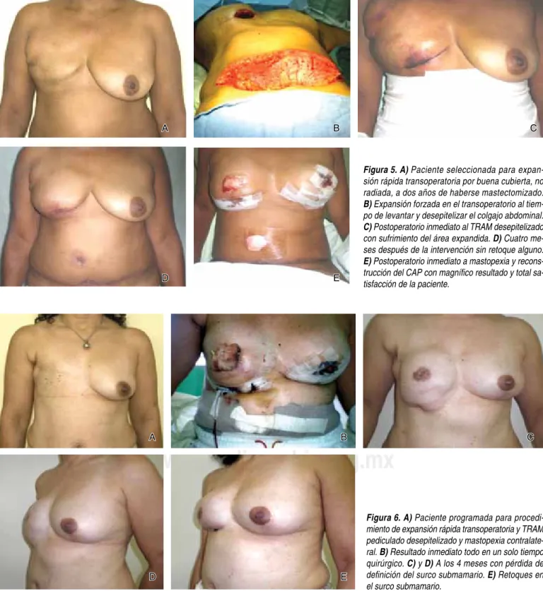 Figura 5. A) Paciente seleccionada para expan-