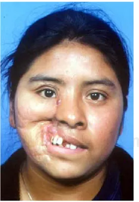 Figura 5. Mujer de 19 años de edad con deformidad severa en la mejilla