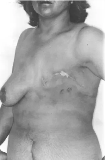 Figura 5A. Vista pre-operatoria de una paciente con mastectomía 18