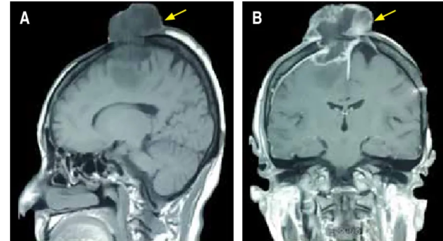 Figura 4.  Angiotomografía: aumento en la perfusión 