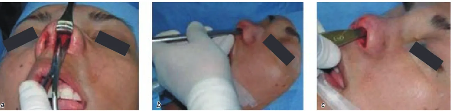 Figura 2. Acceso Sub-SMAS (a), para liberación completa del dorso (b), paredes laterales y punta nasal (c).