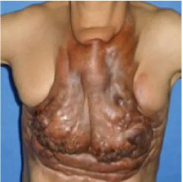 Figura 7.  Estadio V, escleroderma, lupus.