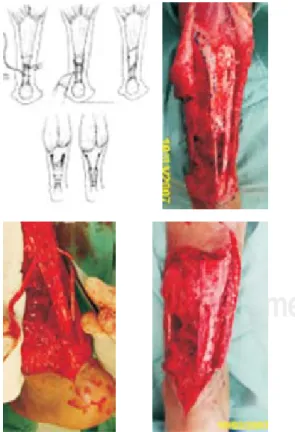 Figura 1. HPAF en 1/3 inferior cara posterior de pierna, con fractura de