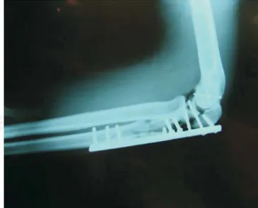 Figura 5. Radiografías AP y lateral de la lesión. Figura 7. Radiografía de control de la osteosíntesis.