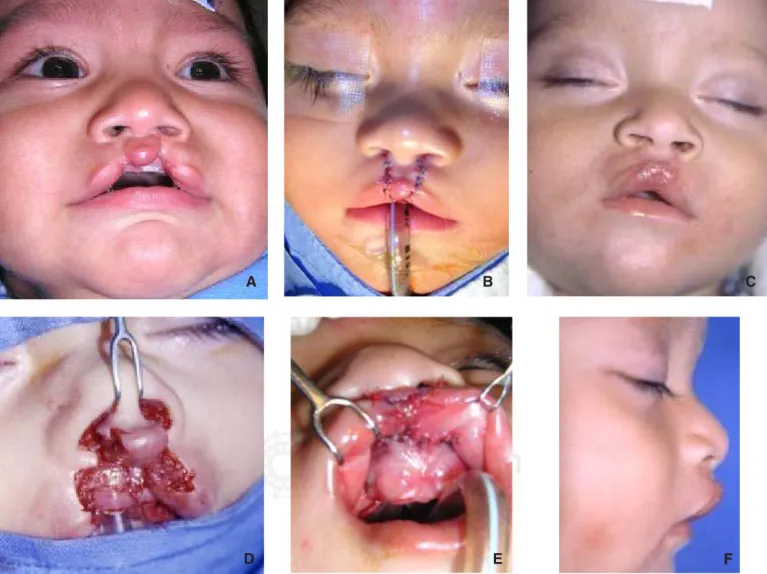 Figura 3. A: Niño con fisura labial bilateral tipo III. B: Tratado con incisiones simulando el filtrum, respetando parte del tubérculo de Cupido, sin incisiones laterales
