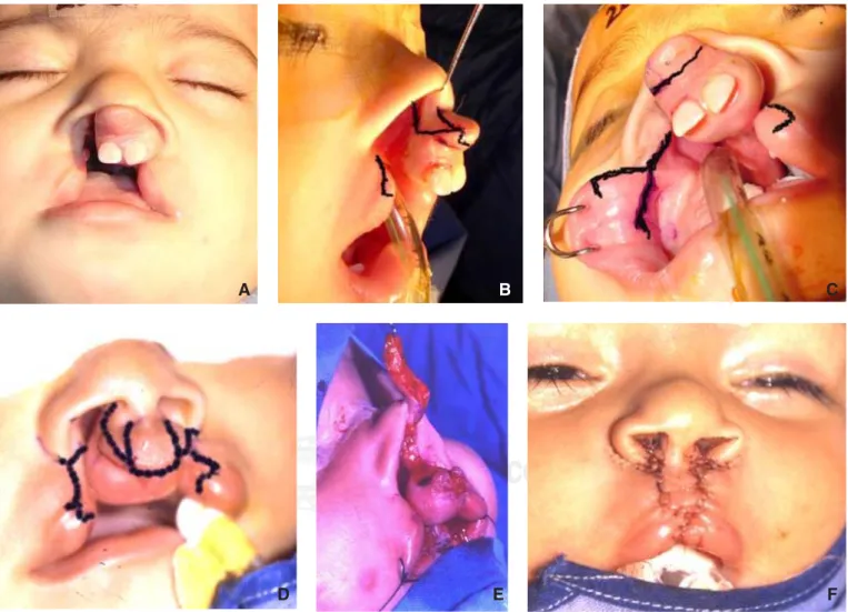 Figura 5. A: Paciente de 10 meses con fisura tipo I. B, C: Planteamiento quirúrgico de incisiones vestibulares