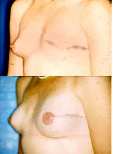 Figura 3. A) Paciente con mastectomía y expansor colocado