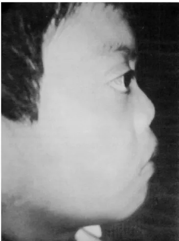Figura 1. Aspecto preoperatorio de frente.