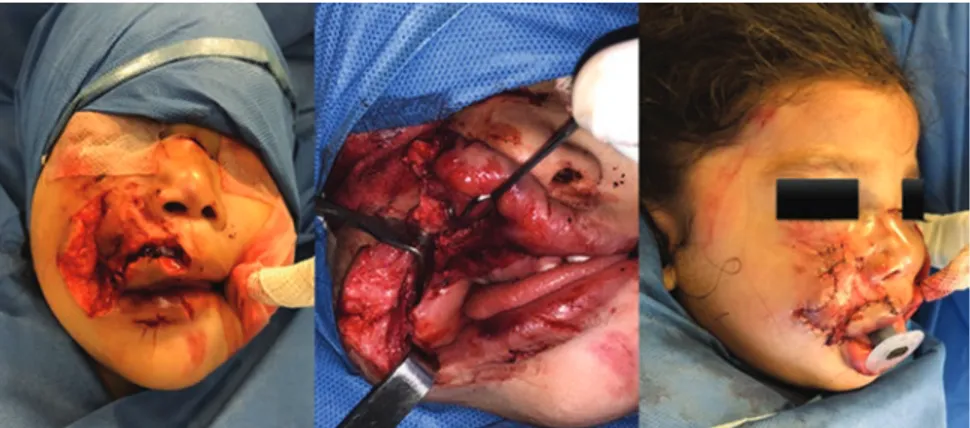 Figura 4. Caso representativo: niña de 3 años víctima de mordedura de perro de raza Pitbull de 6 horas de evolución, con lesión inicial en zonas 