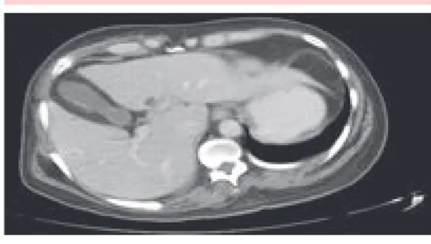 figura 5.  Imagen tomográfica en la que se identifican  metástasis hepáticas.  