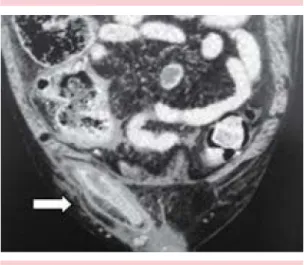figura 1.  Visión frontal de la tomografía computada  abdominal preoperatoria del paciente masculino con  hernia de Amyand