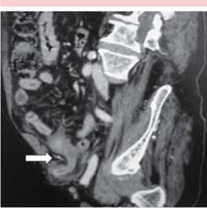 figura 2.  Visión lateral de la tomografía computada  abdominal del paciente masculino con hernia de  Am-yand
