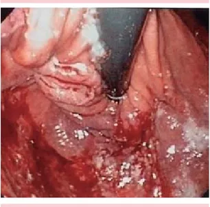 figura 1.  Panendoscopia del caso 1 que muestra datos  de isquemia y sangrado en el fundus gásstrico