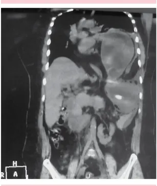 figura 2.  Tomografía simple toracoabdominal, corte  coronal con imagen hipodensa en el hemitórax  iz-quierdo que se comunica a la cavidad abdominal,  con niveles hidroaéreos y engrosamiento de pared.