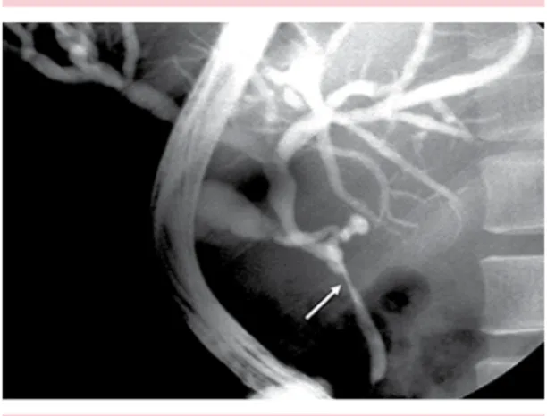 figura 1.  Colangiopancreatografía retrógrada endos- endos-cópica. Se muestra la estenosis del conducto biliar  principal (flecha) causada por compresión vascular