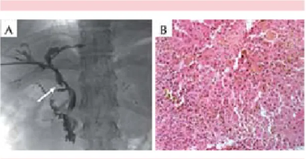 figura 2.  Colangiopancreatografía retrógrada endos- endos-cópica y biopsia hepática. A